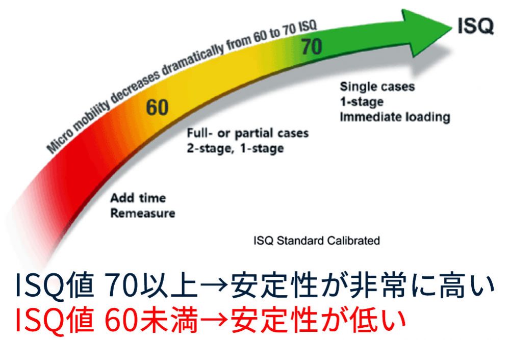 インプラント安定指数（ISQ値）